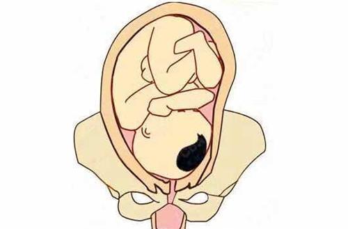 胎儿臀位与缺氧的关系
